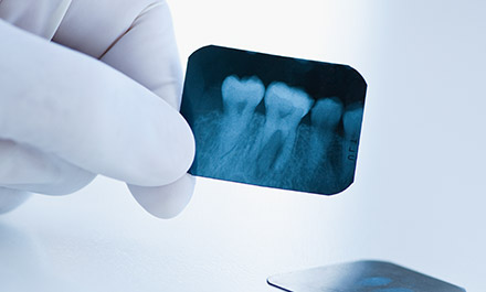 Root Canal Therapy Timberlands Dental Care Burnaby